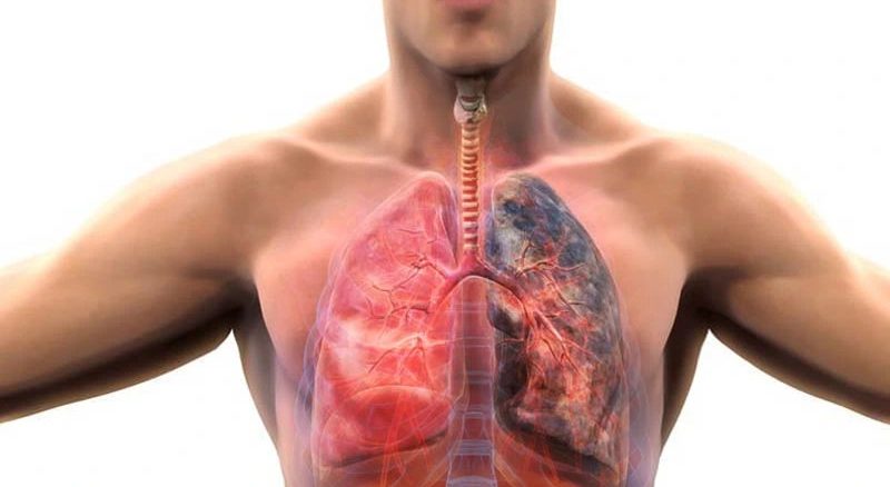 COPD — శ్వాస తీసుకోవడం క్రమంగా కష్టమయ్యే పరిస్థితి